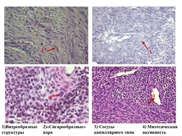 3) Сосуды капиллярного типа 1 2 3 1)Вихреобразные структуры 2)«Сигарообразные» ядра 4 4) Митотическая активность