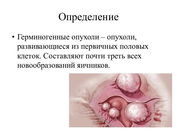 Определение Герминогенные опухоли – опухоли, развивающиеся из первичных половых клеток. Составляют почти треть всех новообразований яичников.