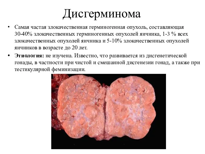 Дисгерминома Самая частая злокачественная герминогенная опухоль, составляющая 30-40% злокачественных герминогенных опухолей яичника,