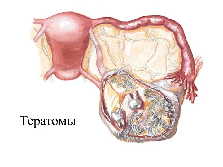 Тератомы