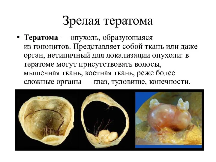 Зрелая тератома Тератома — опухоль, образующаяся из гоноцитов. Представляет собой ткань или