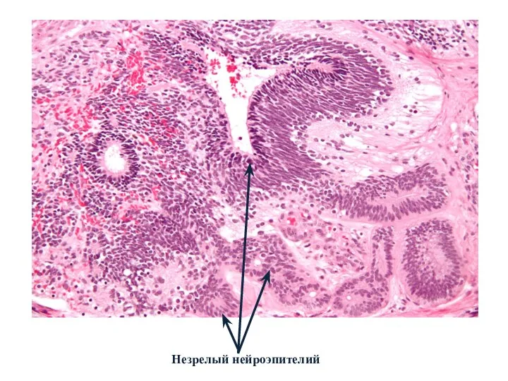 Незрелый нейроэпителий