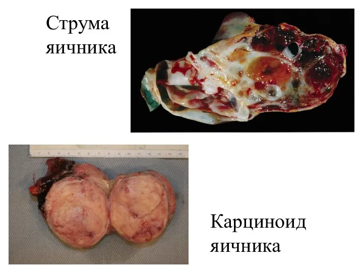 Струма яичника Карциноид яичника