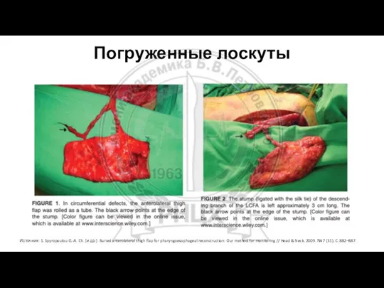 Погруженные лоскуты Источник: 1. Spyropoulou G.-A. Ch. [и др.]. Buried anterolateral thigh