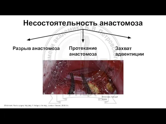 Несостоятельность анастомоза Источник: Plastic surgery под ред. P. Neligan, 4-е изд., London: