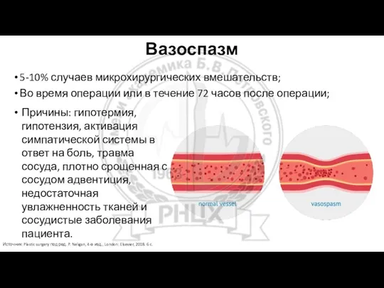 Вазоспазм 5-10% случаев микрохирургических вмешательств; Во время операции или в течение 72