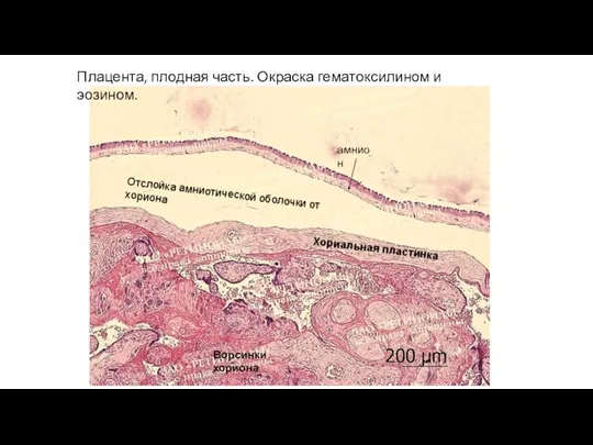 Плацента, плодная часть. Окраска гематоксилином и эозином. амнион Отслойка амниотической оболочки от