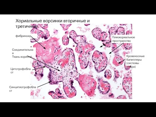 Хориальные ворсинки вторичные и третичные. Цитотрофобласт Синцитиотрофобласт Соединительная Ткань хориона фибриноид Гемохориальное