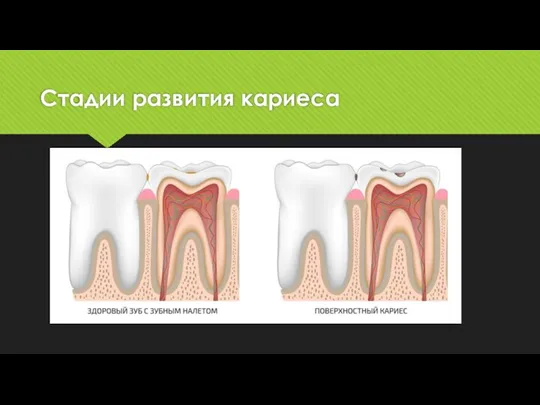 Стадии развития кариеса