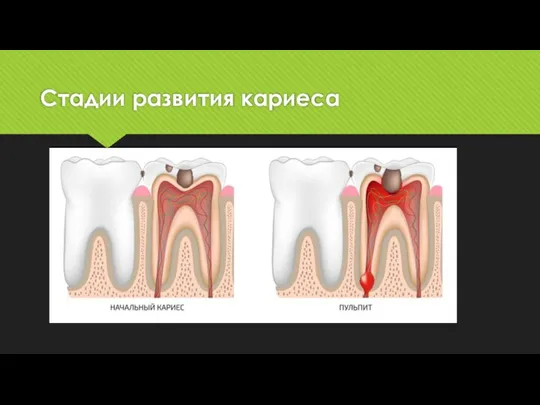 Стадии развития кариеса