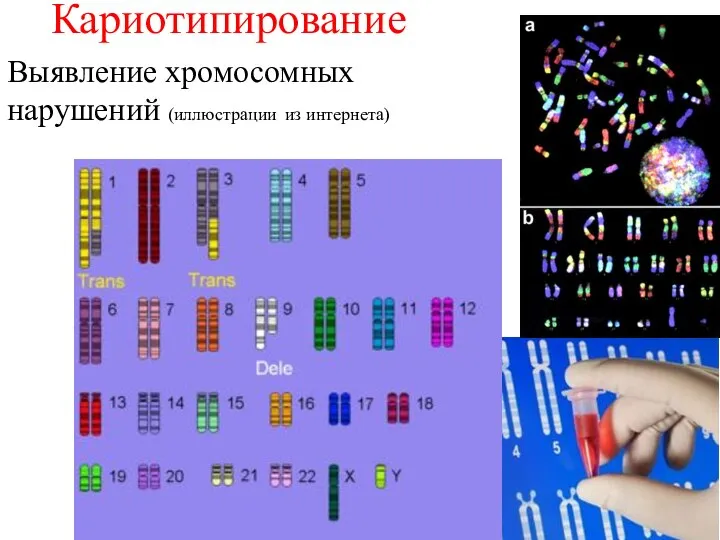 Кариотипирование Выявление хромосомных нарушений (иллюстрации из интернета)