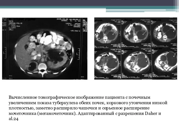 Вычисленное томографическое изображение пациента с почечным увеличением показа туберкулеза обеих почек, коркового