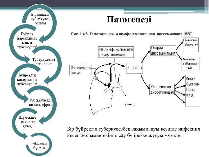 Бір бүйректің туберкулезбен зақымдануы кезінде инфекция несеп жолымен екінші сау бүйрекке жұғуы мүмкін. Патогенезі