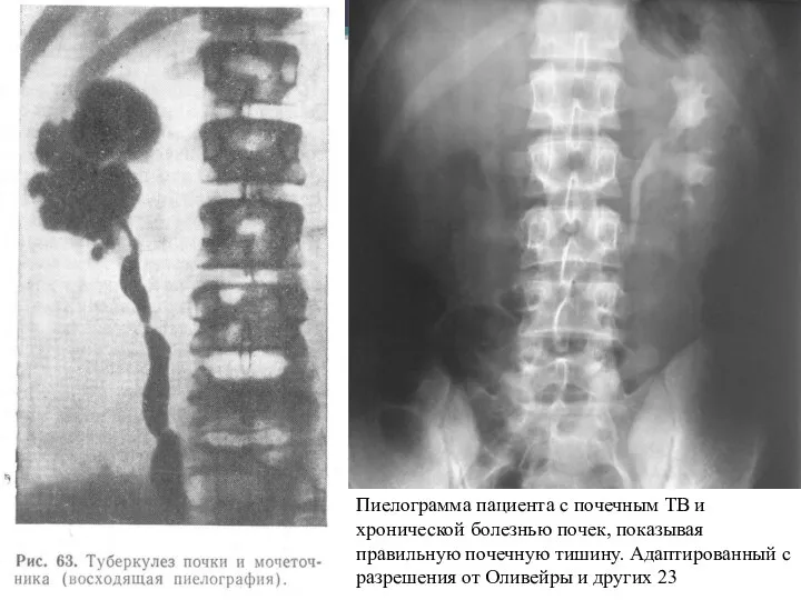 Пиелограмма пациента с почечным TB и хронической болезнью почек, показывая правильную почечную