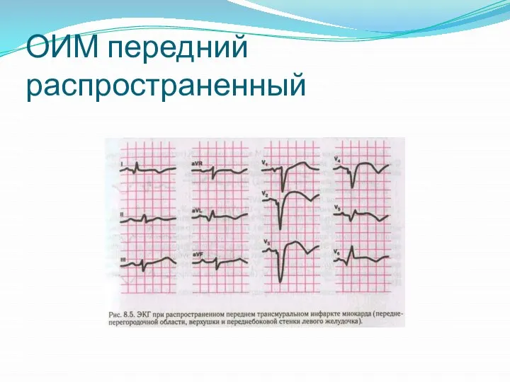 ОИМ передний распространенный