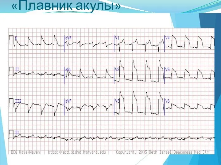 «Плавник акулы»