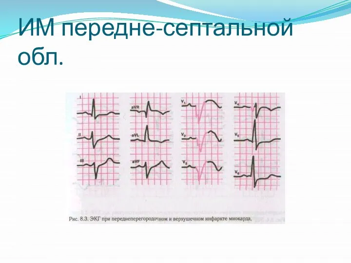 ИМ передне-септальной обл.