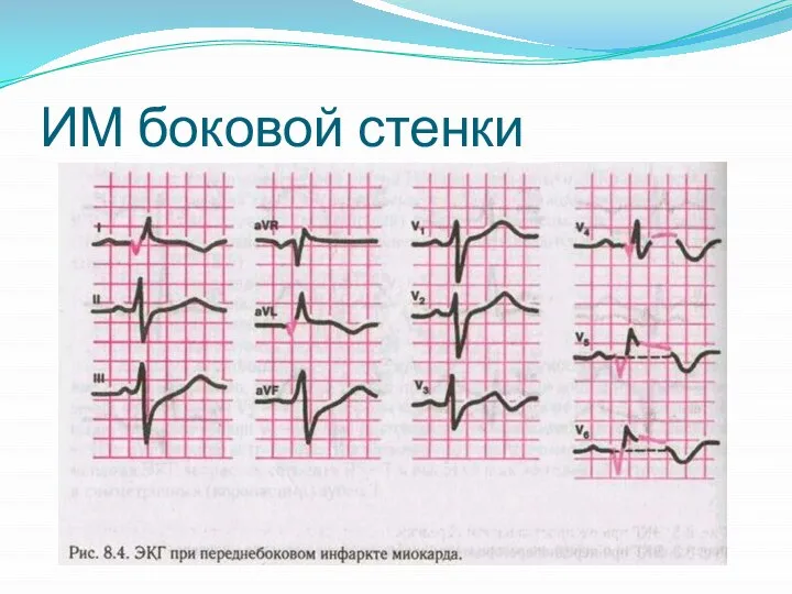 ИМ боковой стенки