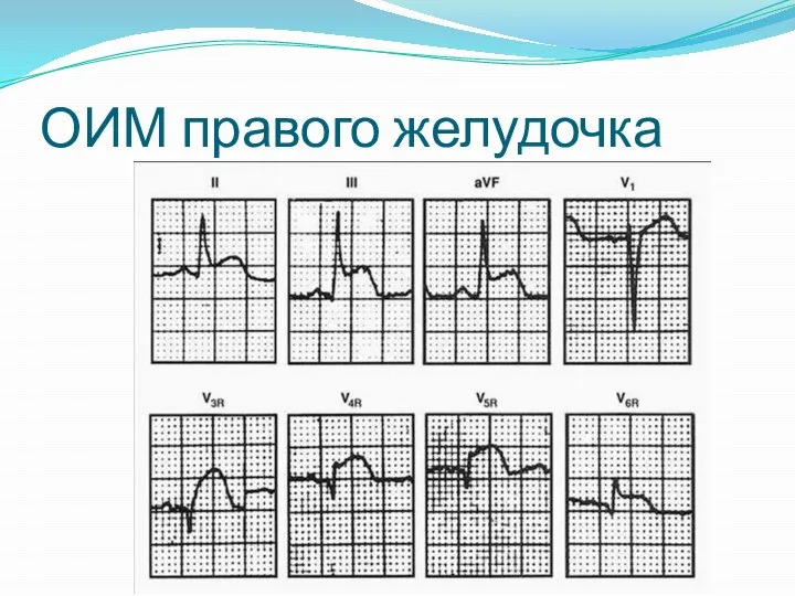 ОИМ правого желудочка