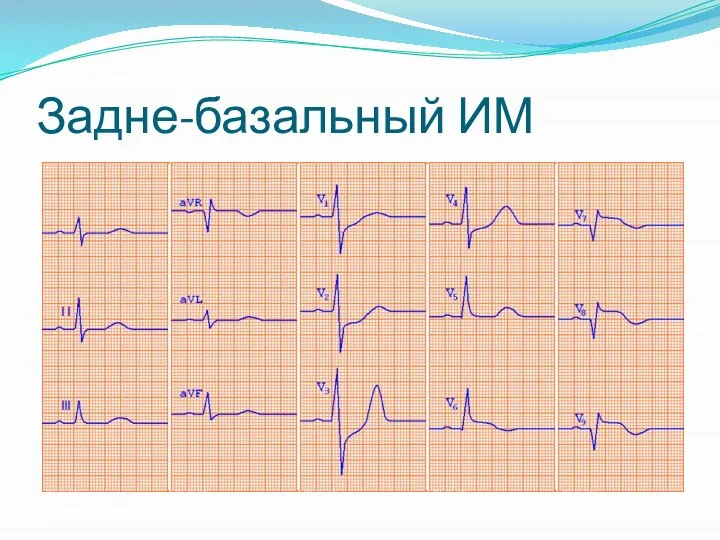 Задне-базальный ИМ