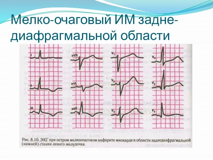 Мелко-очаговый ИМ задне-диафрагмальной области