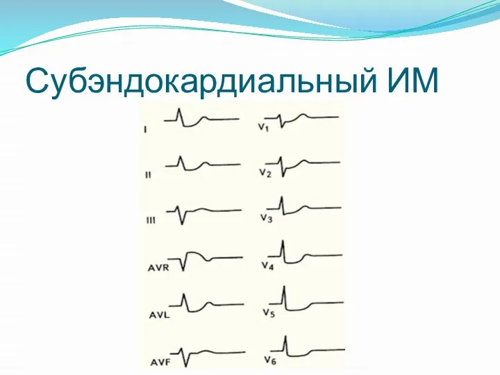 Субэндокардиальный ИМ