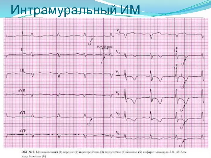 Интрамуральный ИМ