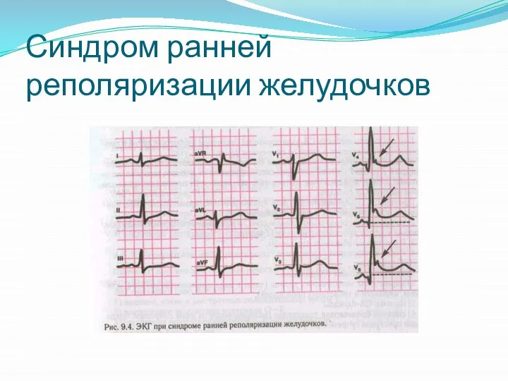 Синдром ранней реполяризации желудочков