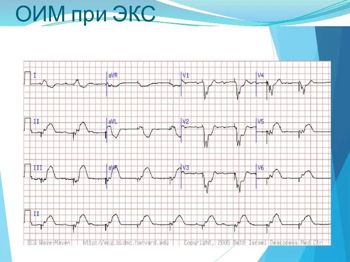 ОИМ при ЭКС