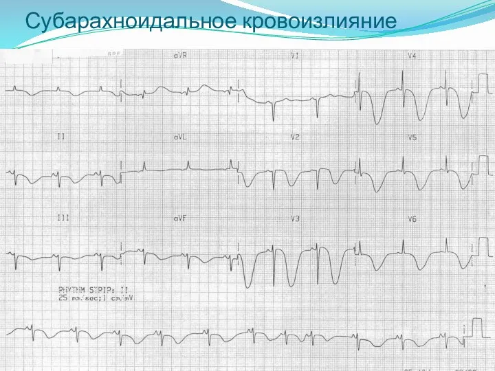 Субарахноидальное кровоизлияние