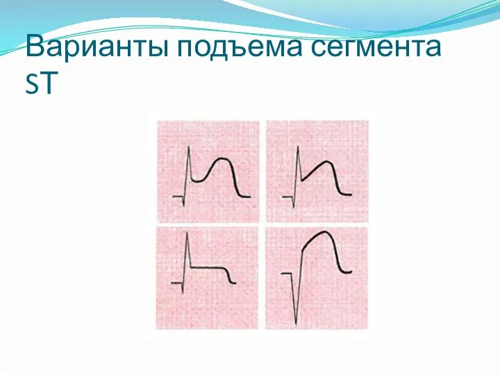 Варианты подъема сегмента SТ