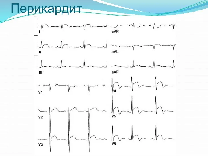 Перикардит