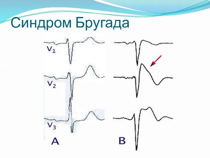 Синдром Бругада