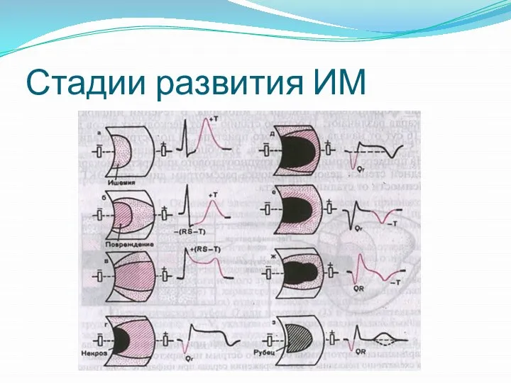 Стадии развития ИМ