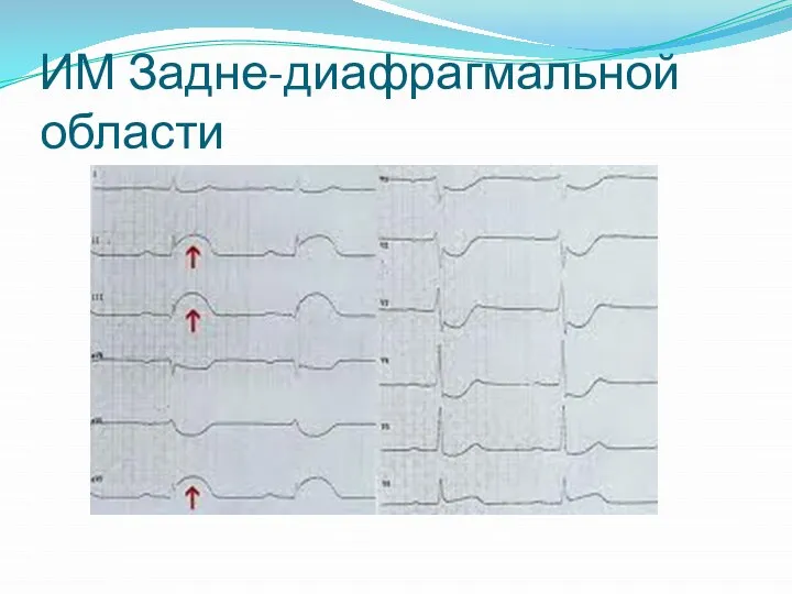 ИМ Задне-диафрагмальной области