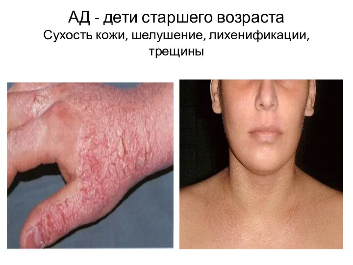АД - дети старшего возраста Сухость кожи, шелушение, лихенификации, трещины
