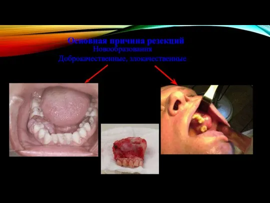 Основная причина резекций Новообразования Доброкачественные, злокачественные