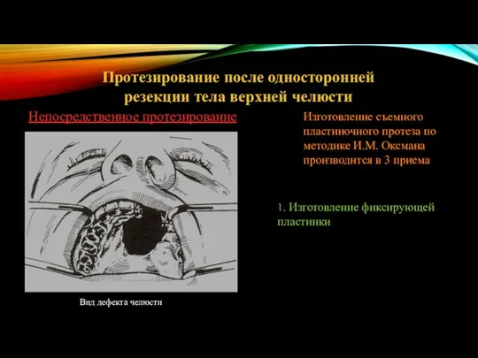 Протезирование после односторонней резекции тела верхней челюсти Непосредственное протезирование Изготовление съемного пластиночного