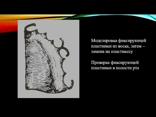 Моделировка фиксирующей пластинки из воска, затем – замена на пластмассу Проверка фиксирующей пластинки в полости рта