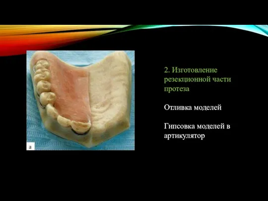 2. Изготовление резекционной части протеза Отливка моделей Гипсовка моделей в артикулятор