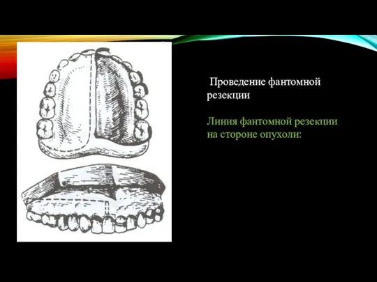 Проведение фантомной резекции Линия фантомной резекции на стороне опухоли: