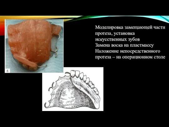 Моделировка замещающей части протеза, установка искусственных зубов Замена воска на пластмассу Наложение