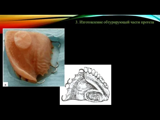 3. Изготовление обтурирующей части протеза