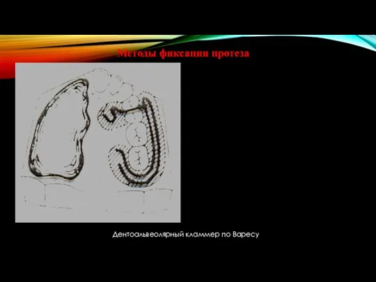 Методы фиксации протеза Дентоальвеолярный кламмер по Варесу