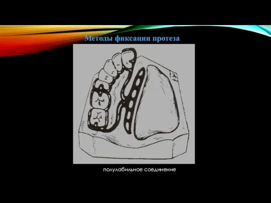Методы фиксации протеза полулабильное соединение