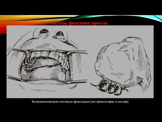 Методы фиксации протеза Телескопическая система фиксации (на премоляры и моляр)