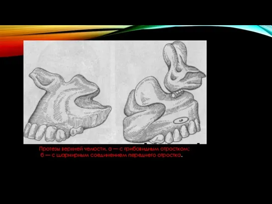 Протезы верхней челюсти. а — с грибовидным отростком; б — с шарнирным соединением переднего отростка.