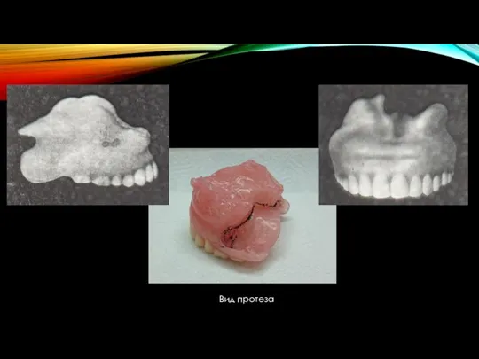 Вид протеза