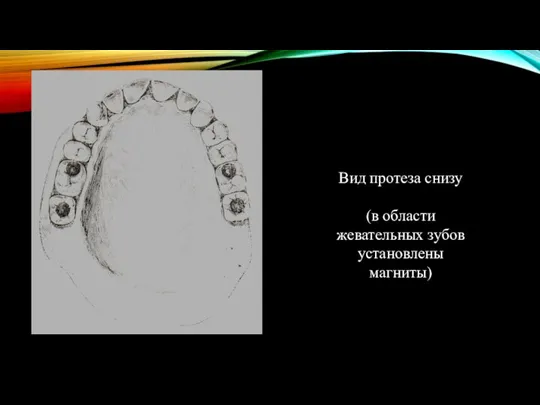 Вид протеза снизу (в области жевательных зубов установлены магниты)