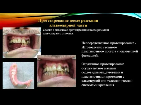 Протезирование после резекции альвеолярной части Непосредственное протезирование - Изготовление съемного пластиночного протеза